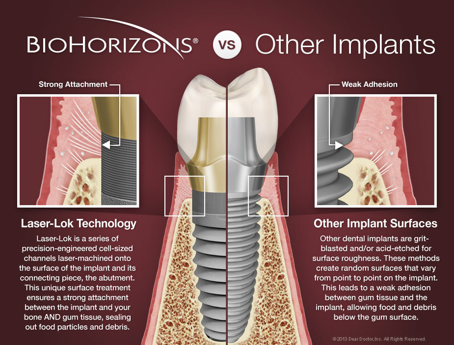 Biohorizons Implants Vs Competitors Large