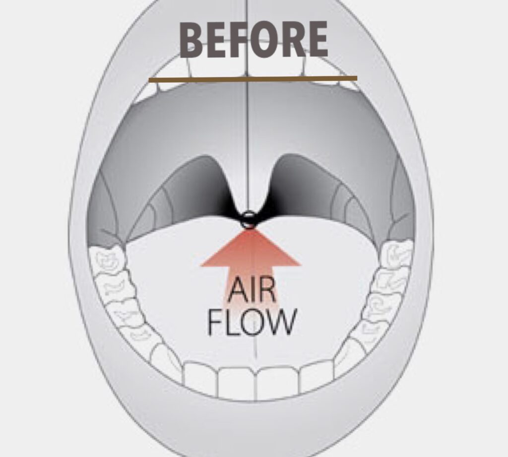 Sleep apnea surgery