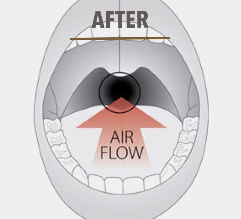 Sleep apnea surgery