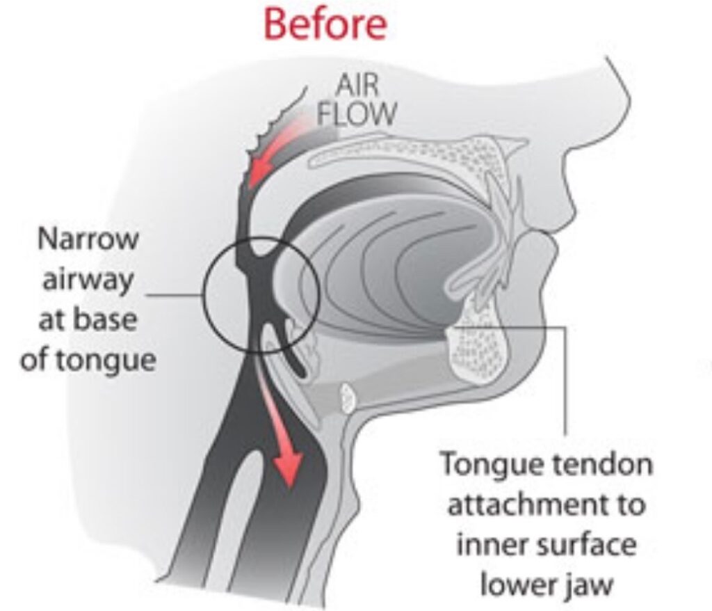 Sleep apnea surgery
