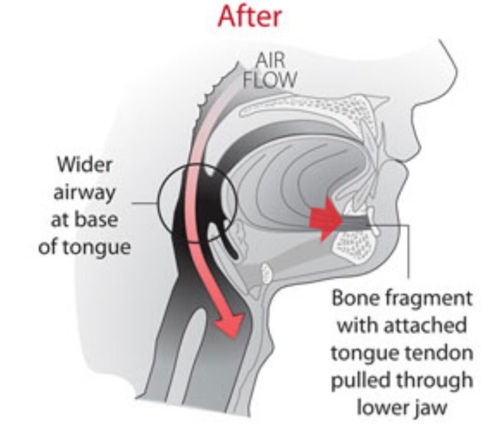 Sleep apnea surgery
