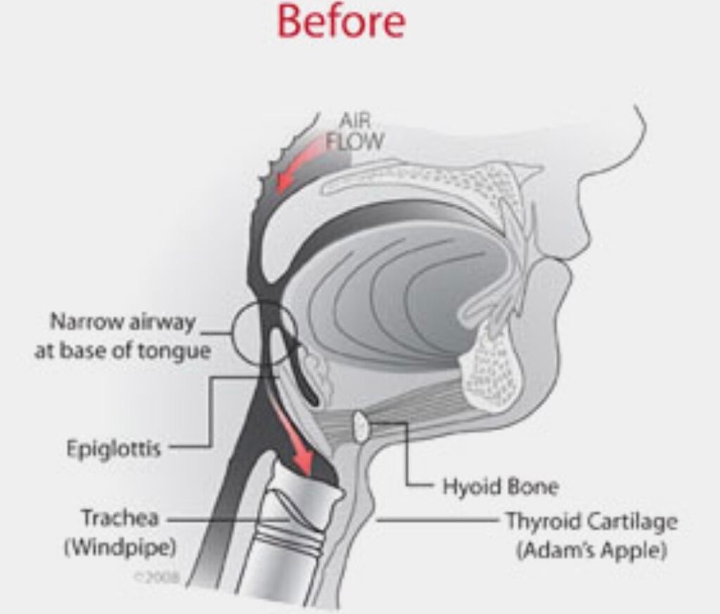 Sleep apnea surgery