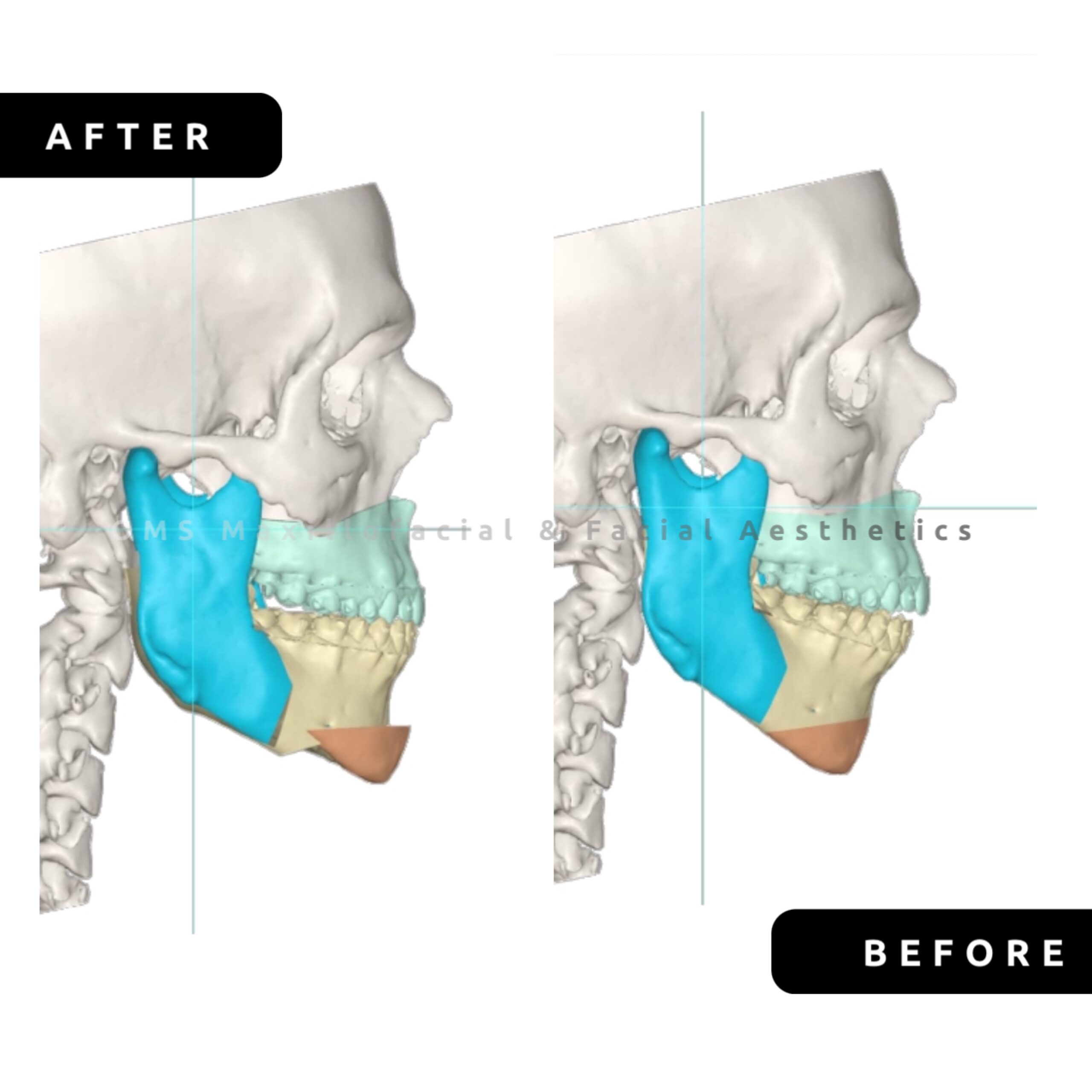 OMS | Guided Orthognathic Surgery