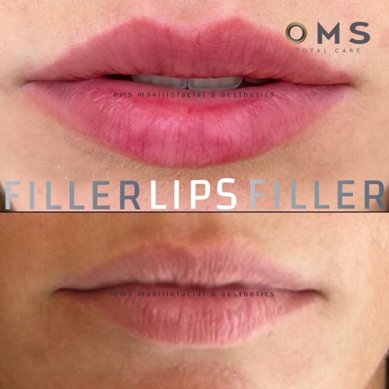O.M.S. Lip Injection