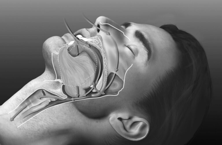 Sleep Apnea